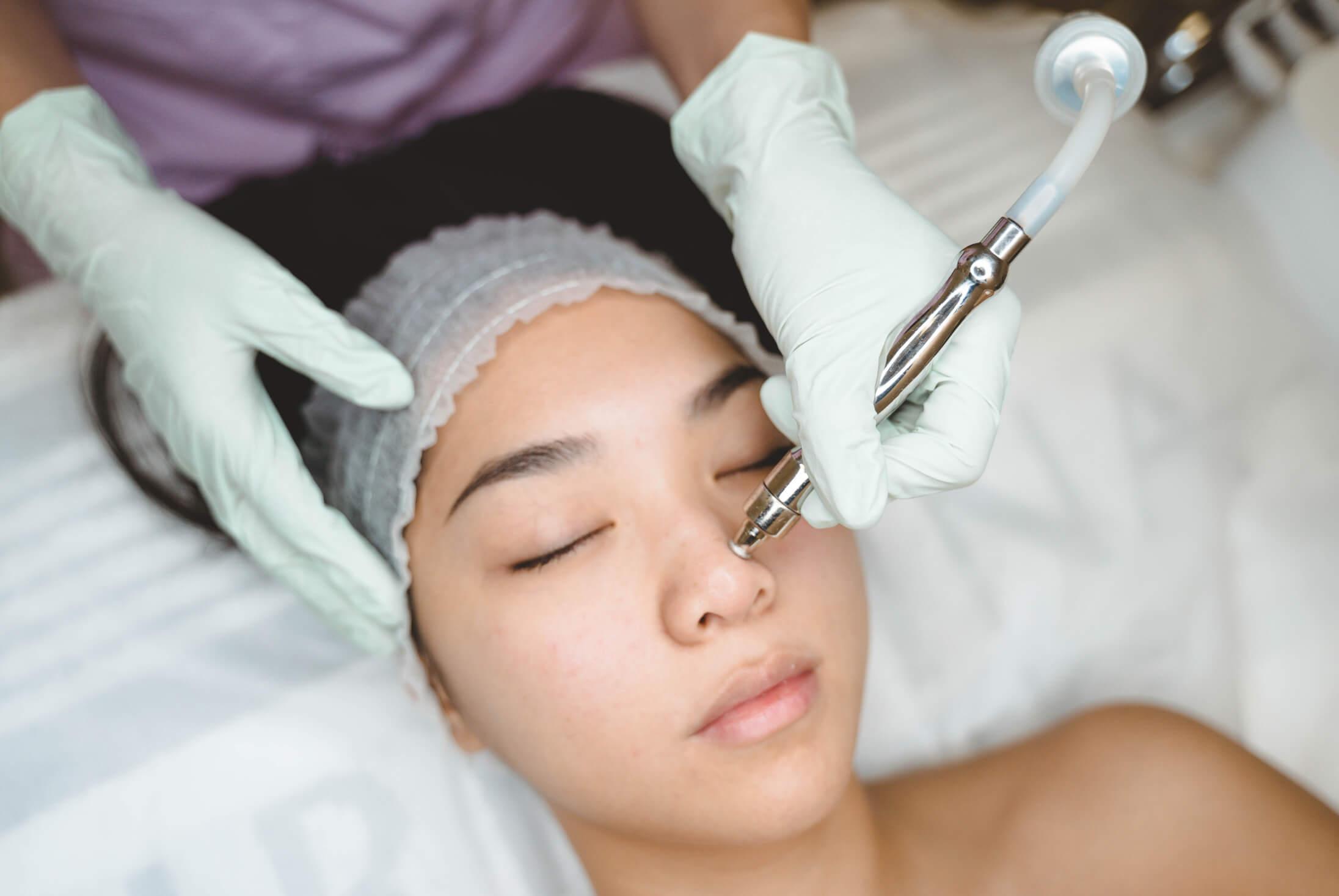 microdermabrasion
